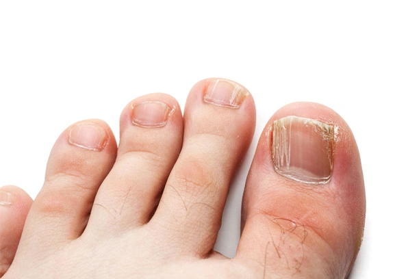 Deforme Tırnak Bakımı<