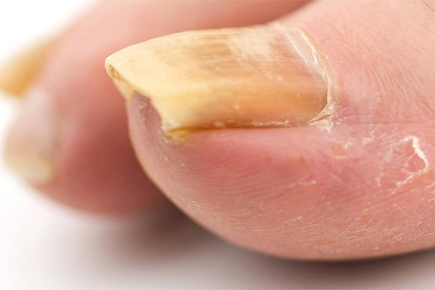 kalınlaşmış tırnak bakımı beylikdüzü