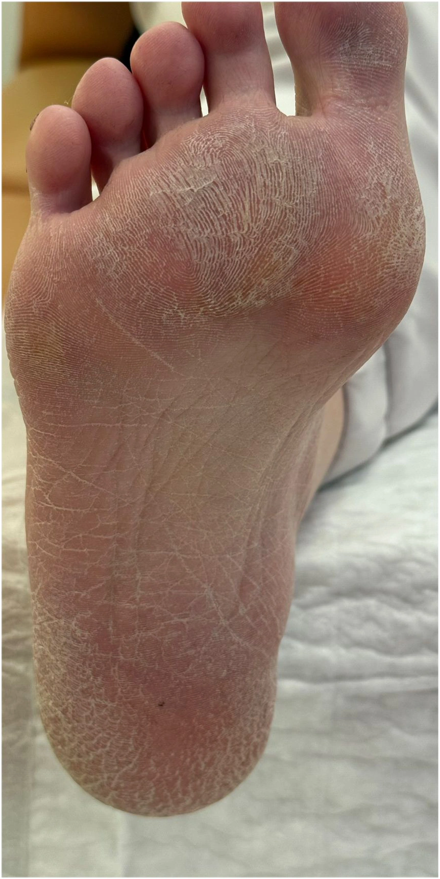Ayak Tabanında Deri Sertleşmesi