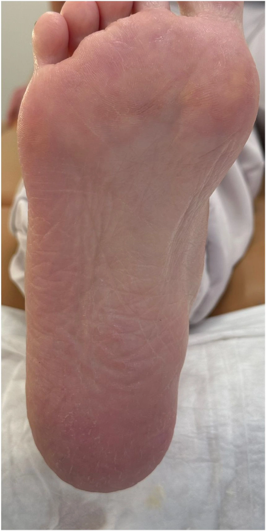 Ayak Tabanında Deri Sertleşmesi