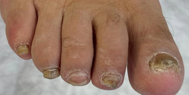 Medikal Tırnak Bakımı