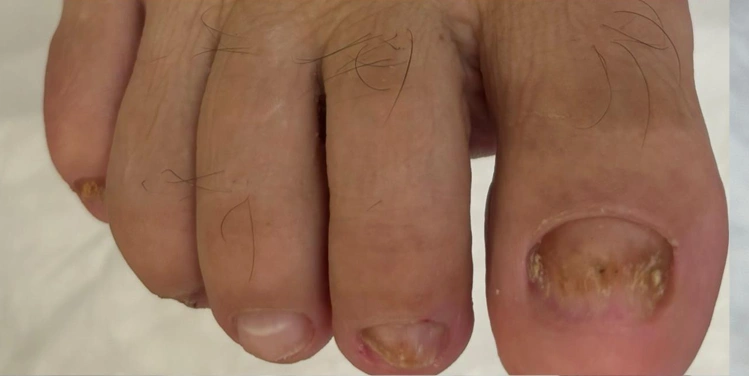 Medikal Tırnak Bakımı