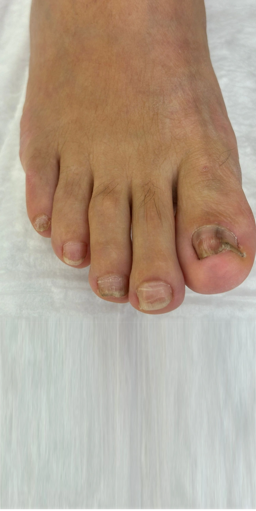 Tırnak Batması Sorunu