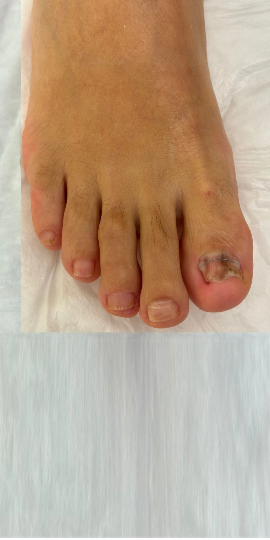 Tırnak Batması Sorunu