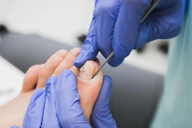 Beylikdüzü Batık Tırnak Tel Uygulaması