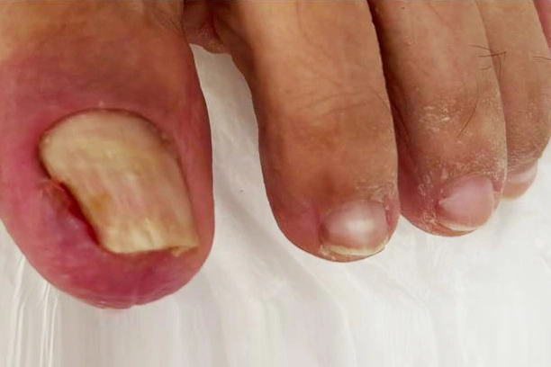 beylikdüzü tırnak batması